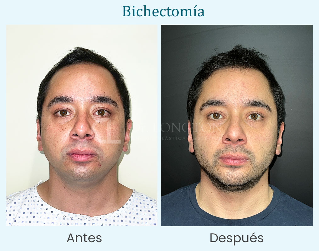 antes y después bichectomia