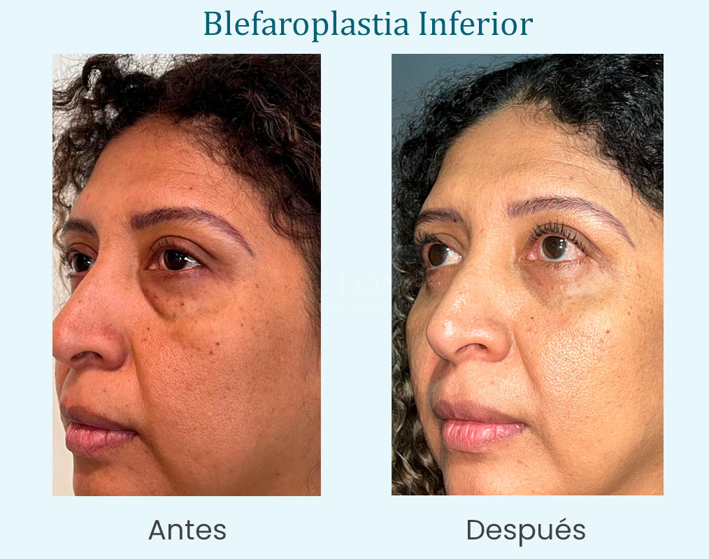 antes y después blefaroplastia