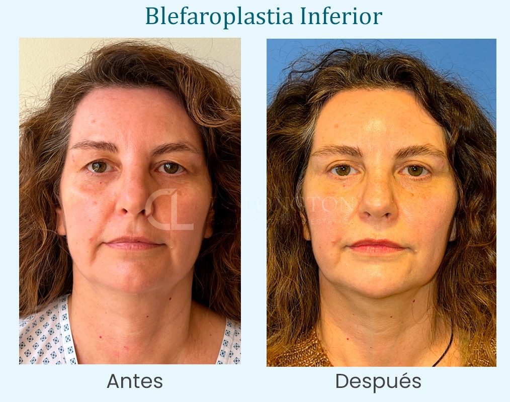 blefaroplastia antes y después caso