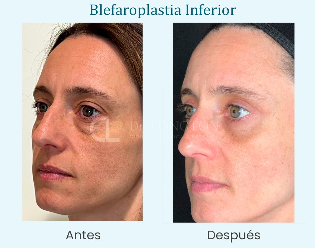 blefaroplastia antes y después