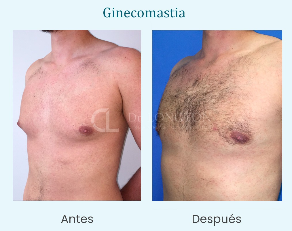 ginecomastia antes y después