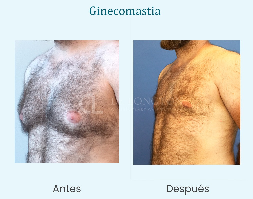 antes y despué ginecomastia