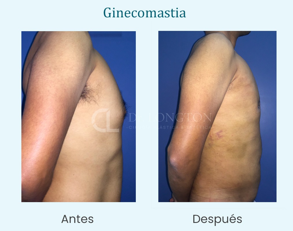 ginecomastia caso de exito