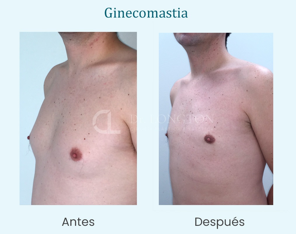 ginecomastia antes y después