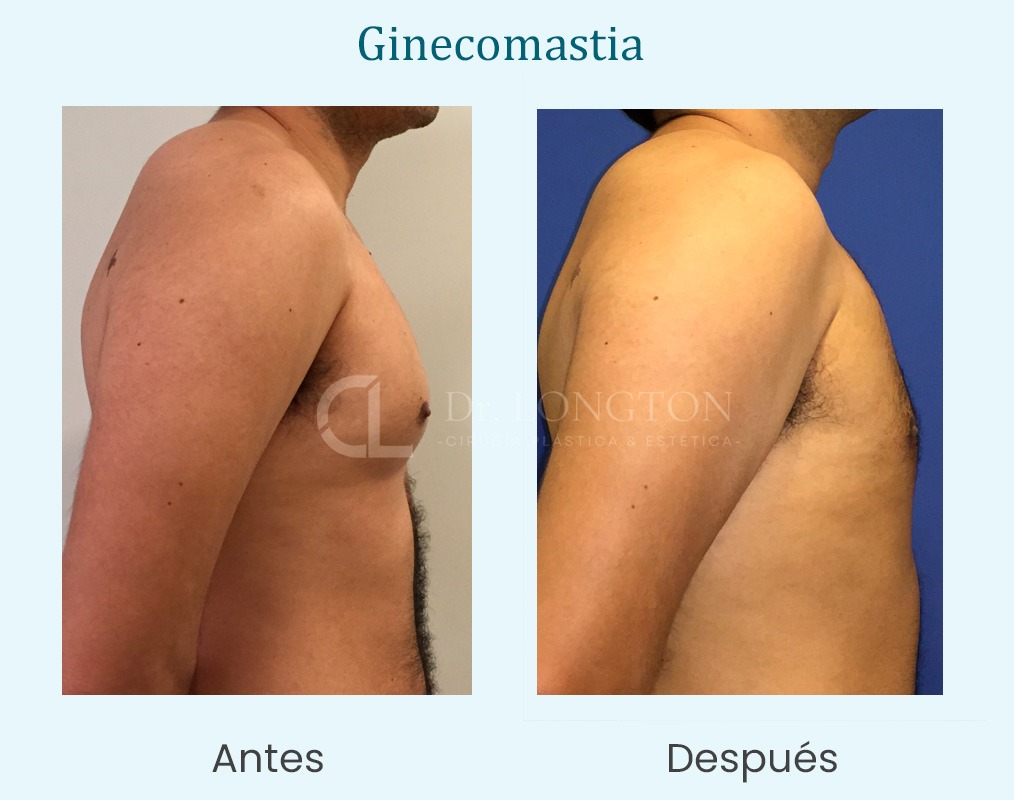 ginecomastia antes y después