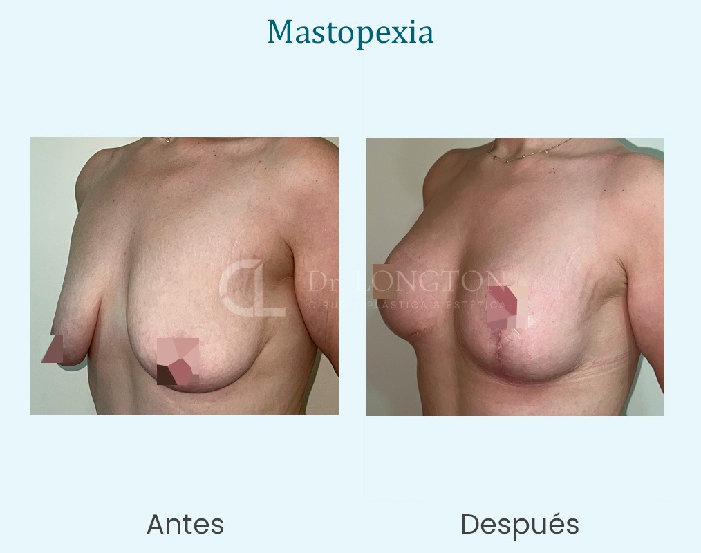 mastopexia antes y después en mastopexia