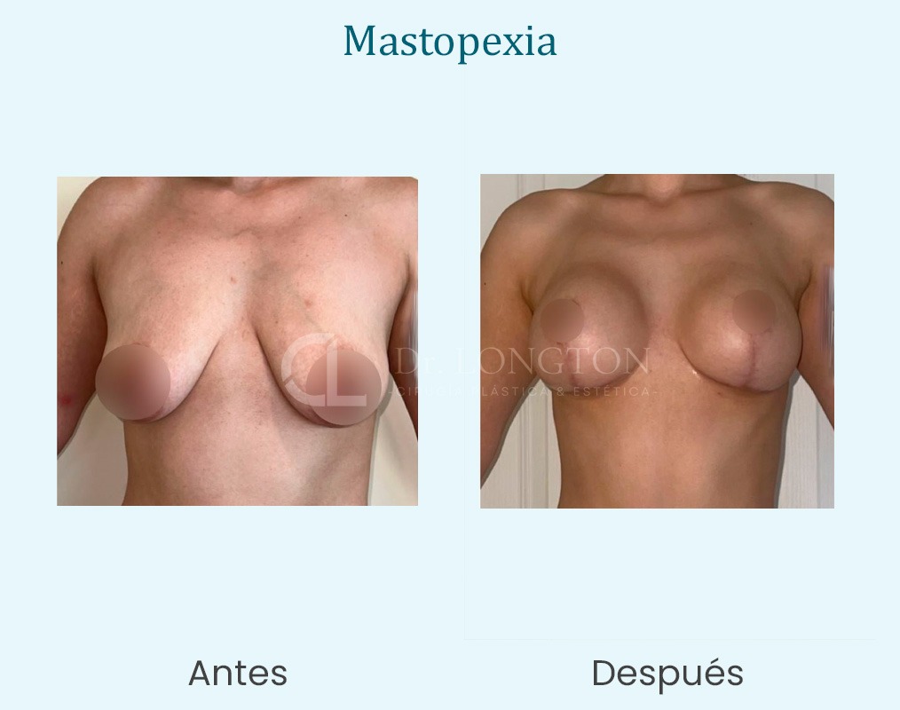 antes y después matopexia