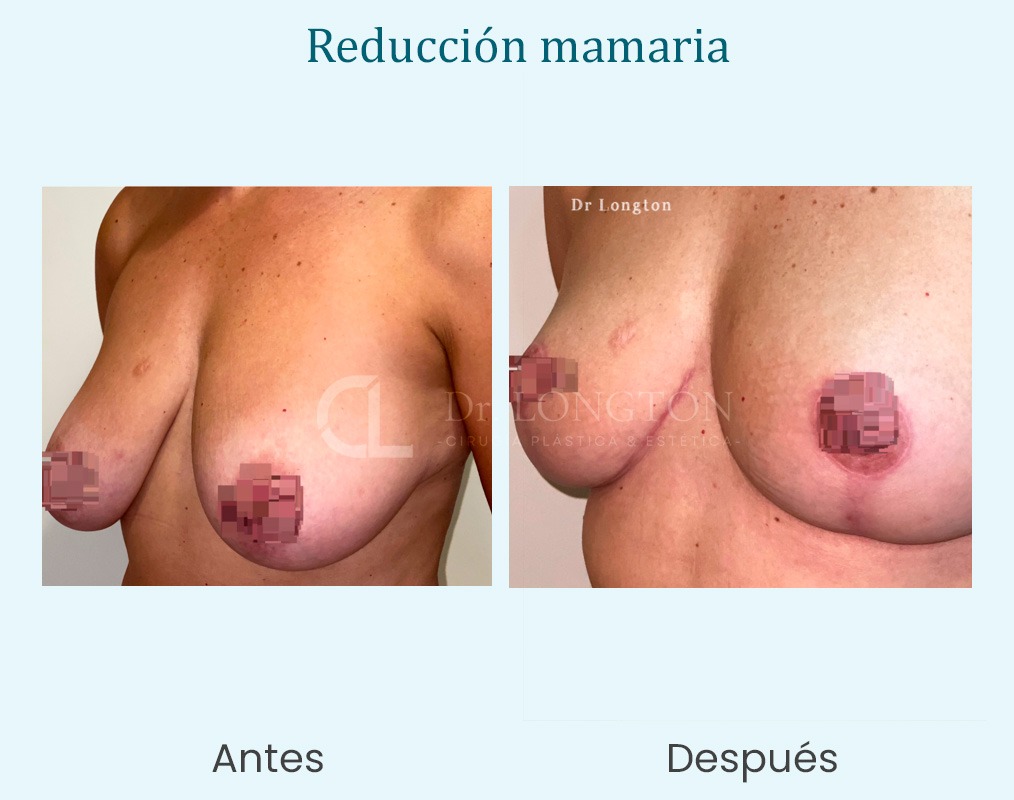 reducción mamaria antes y después caso