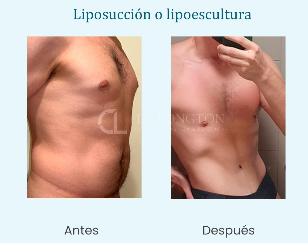 cirugía lipoescultura antes y después