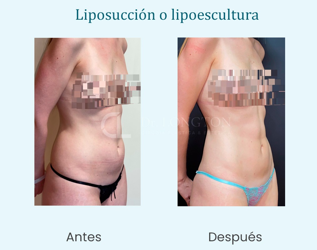 cirugía lipoescultura