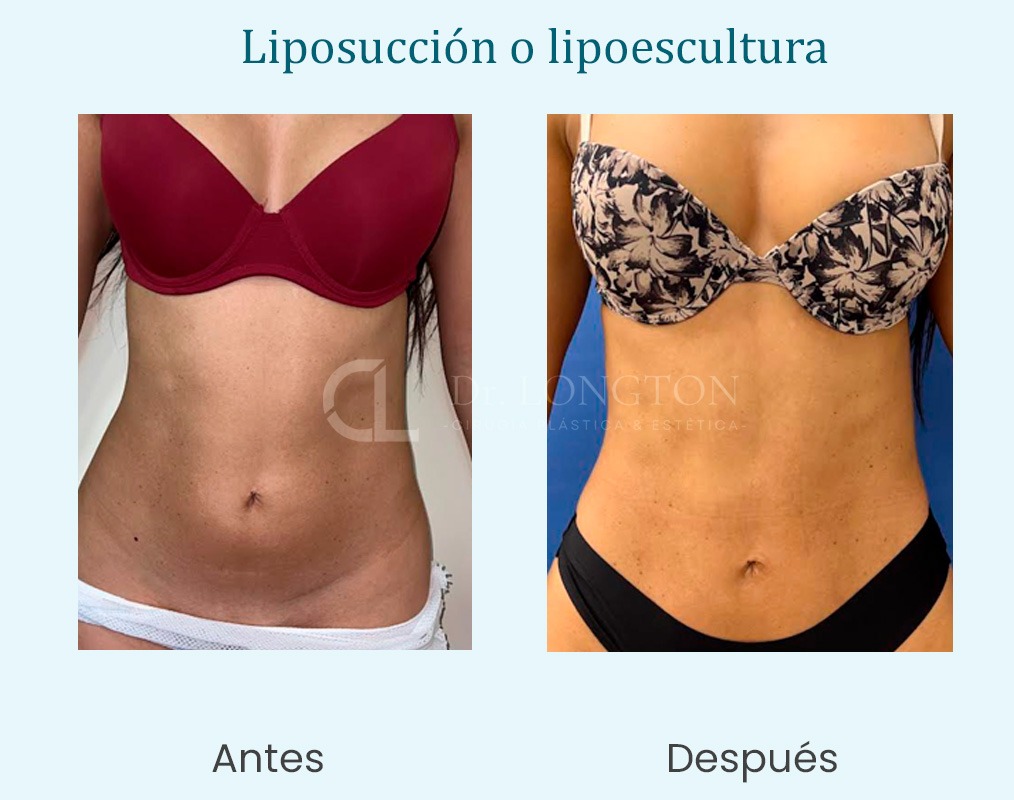 lipoescultura, antes y después