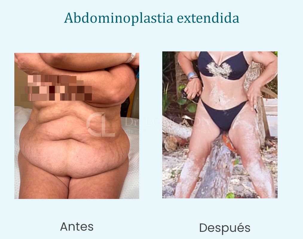 abdominoplastia antes y después santiago