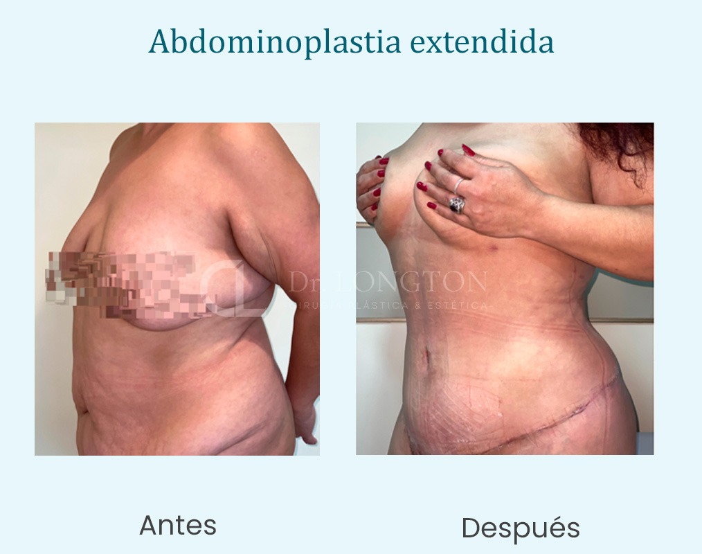 abdominoplastia extendida