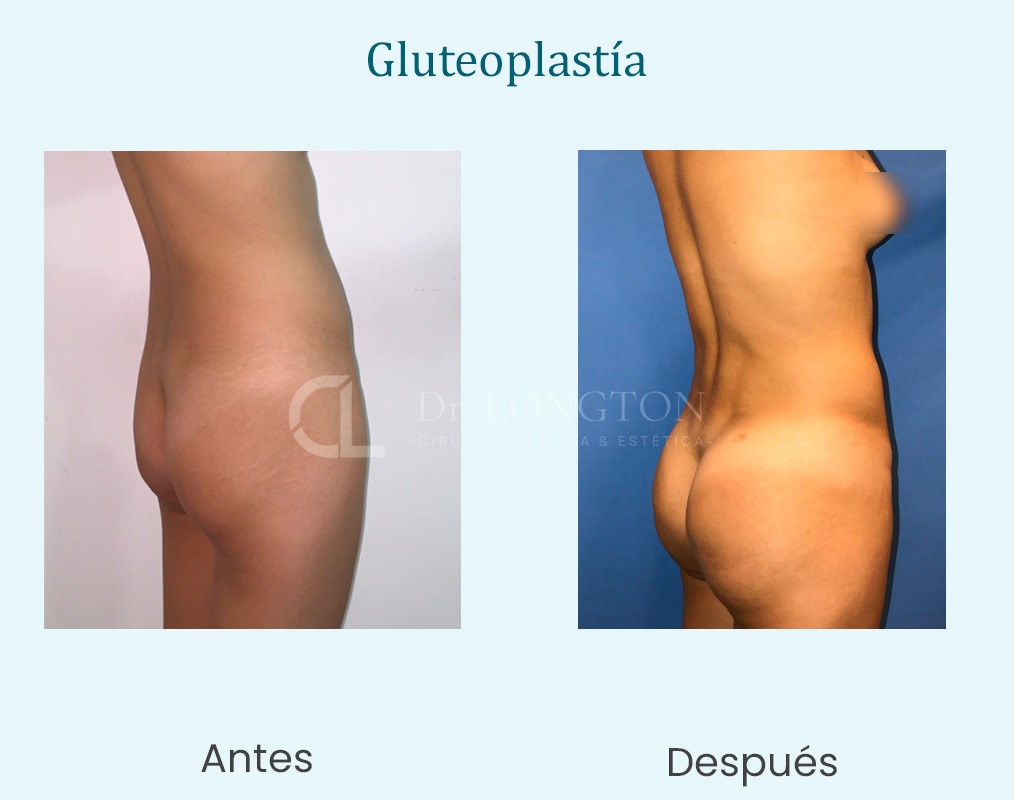 gluteoplastia antes y después santiago