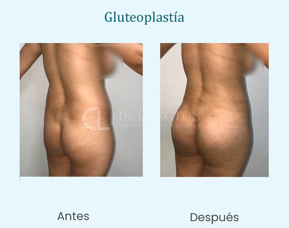 gluteoplastia antes y después caso