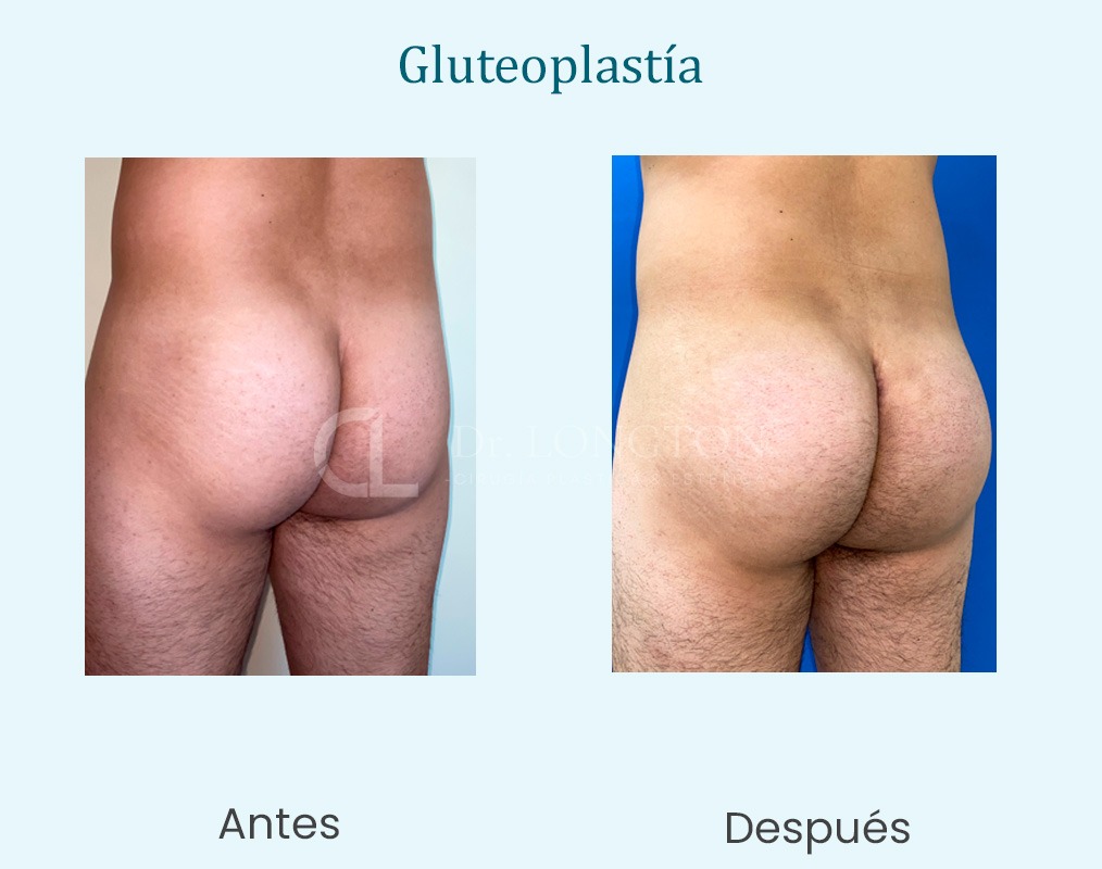 gluteoplastia antes y después