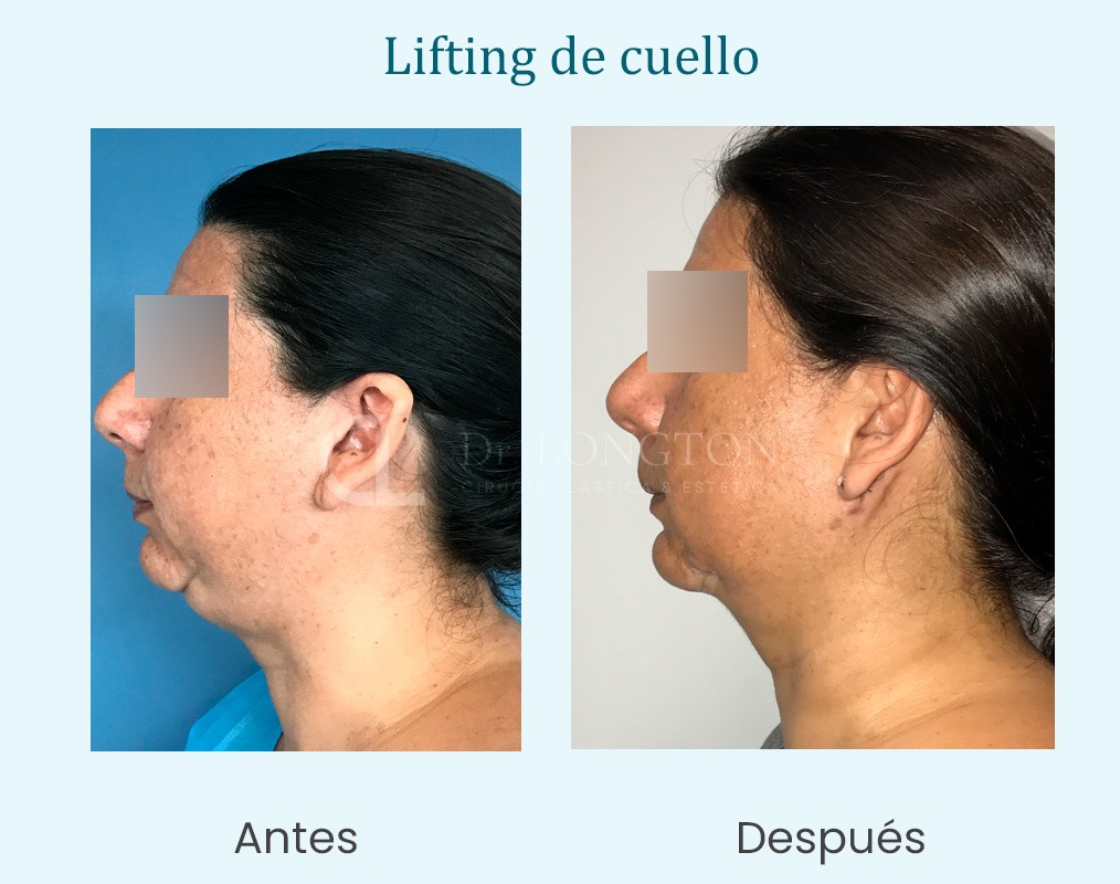 lifting de cuello antes y después