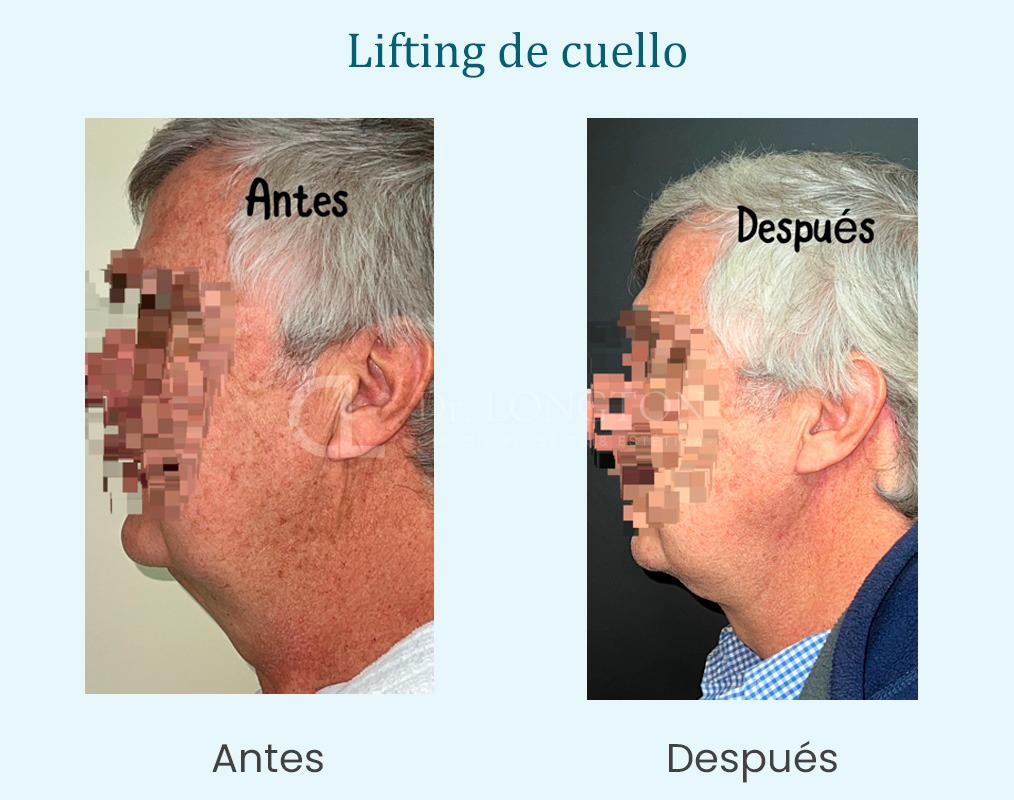 lifting de cuello antes y después