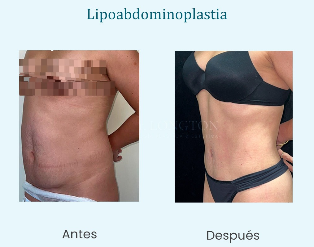 lipoabdominoplastia cerca de mi