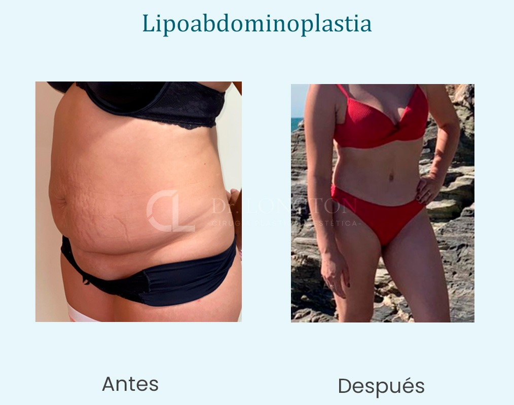 lipoabdominoplastia antes y después ejemplo