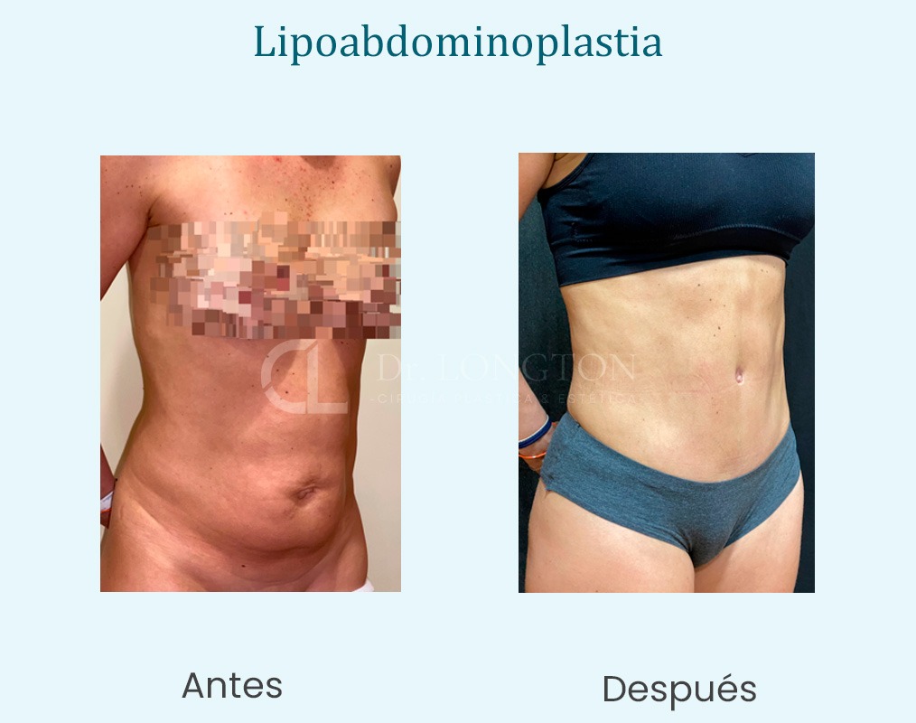 lipoabdominoplastia caso de exito