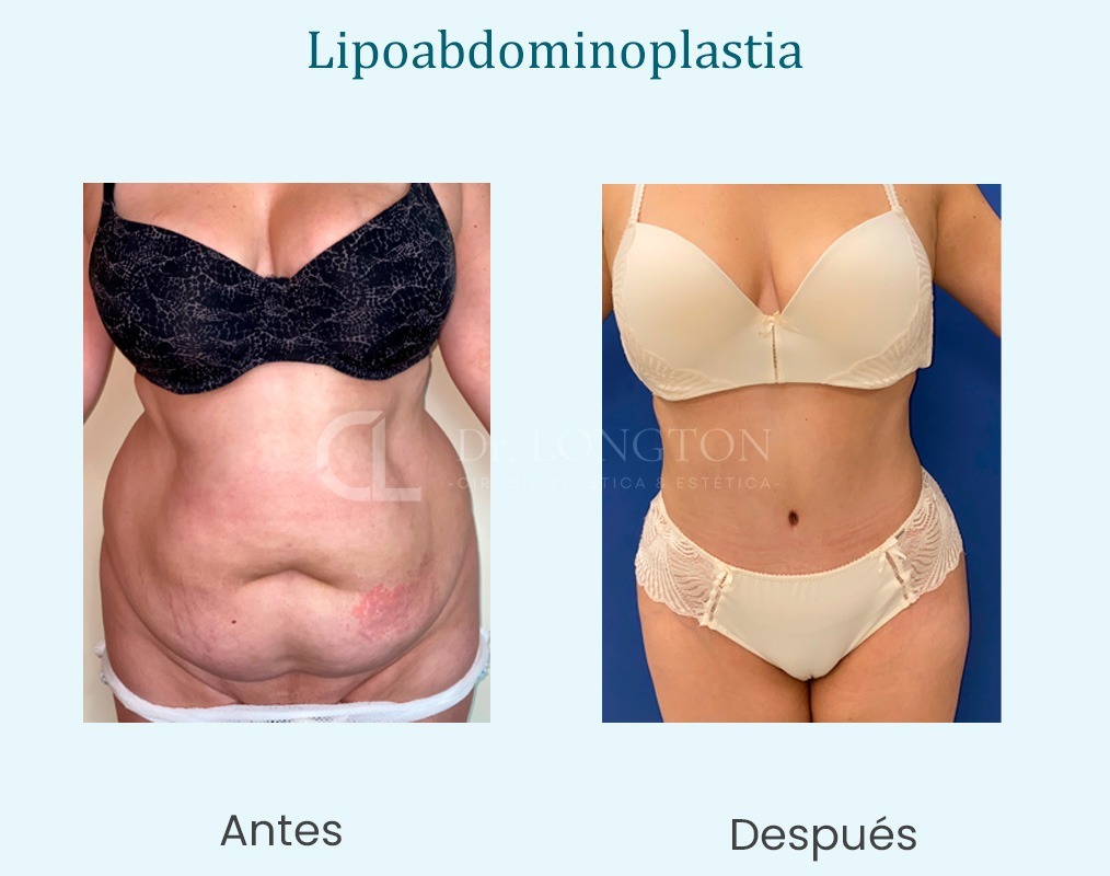 lipoabdominoplastia santiago