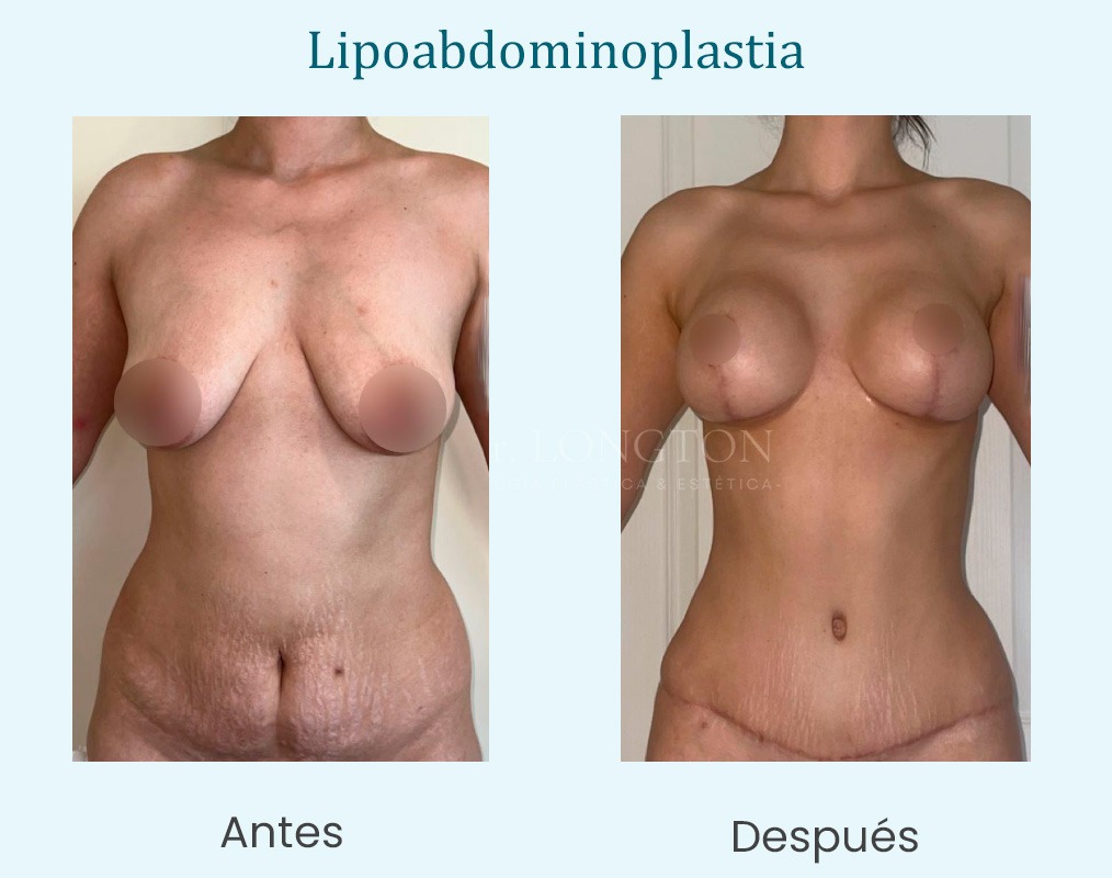 lipoabdominoplastia antes y después