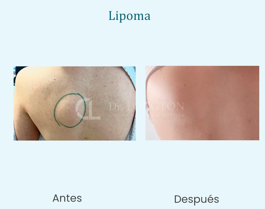 lipoma eliminar