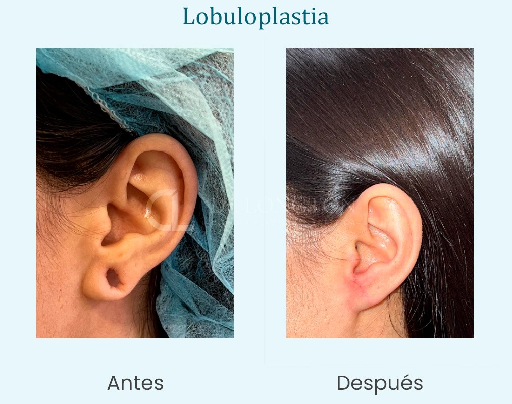 lobuloplastia reparación antes y después