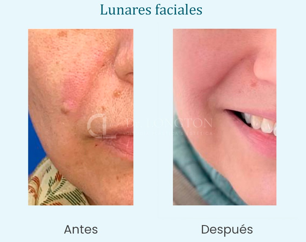 lunares faciales antes y después