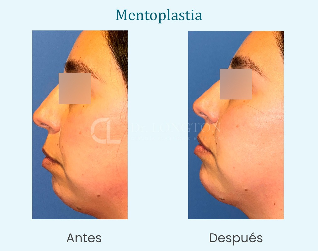 antes y después mentoplastia caso