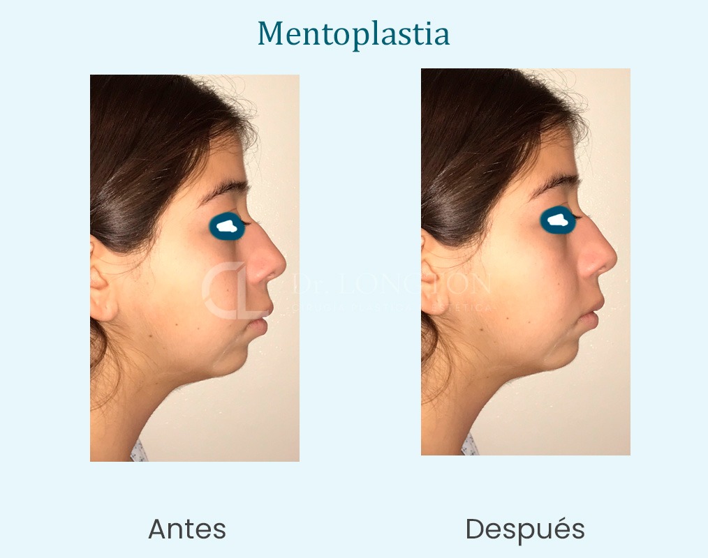 cirugía mentoplastia antes y después