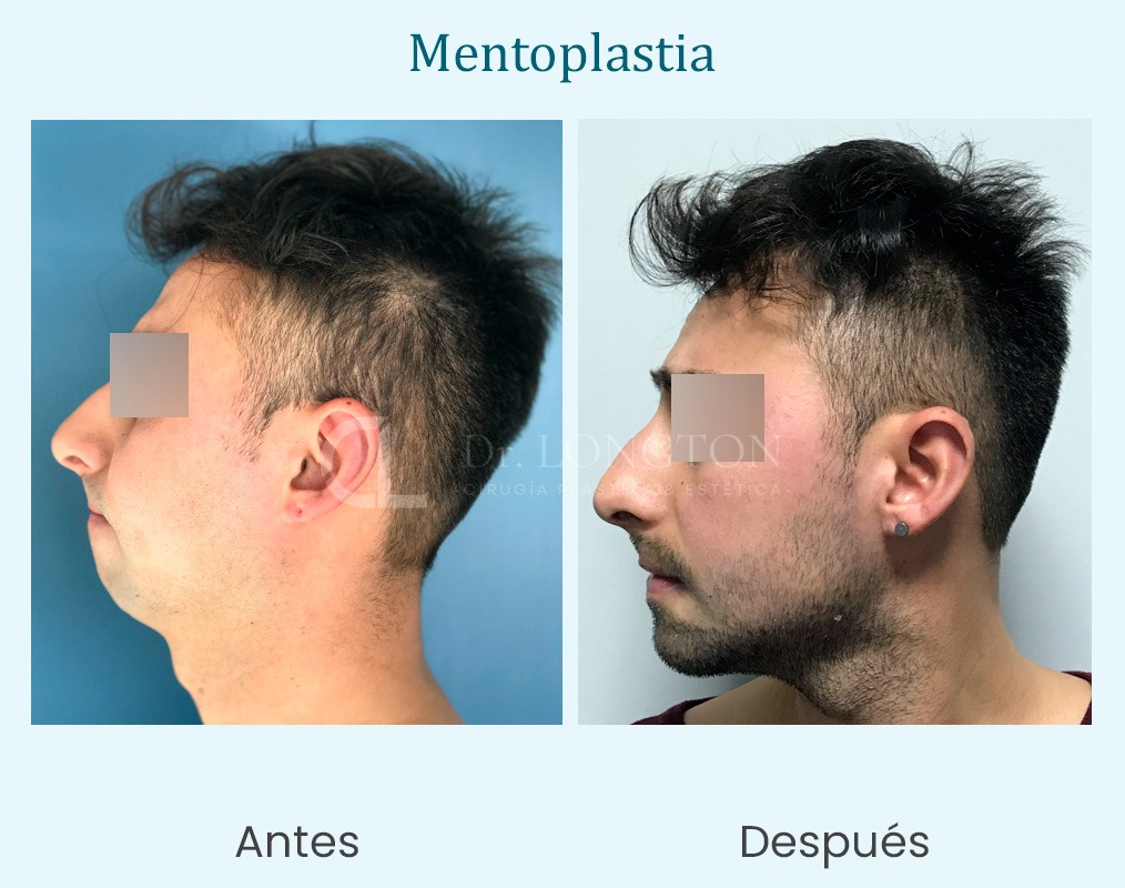 mentoplastia antes y después