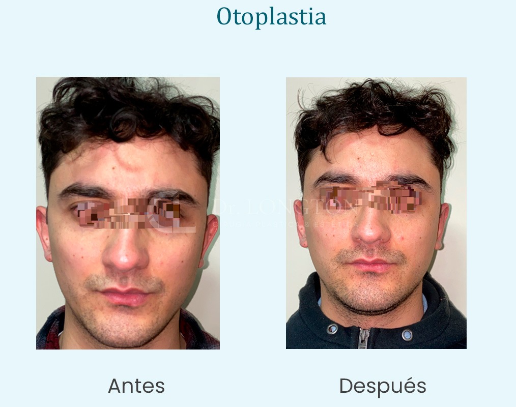 otoplastia antes y después si