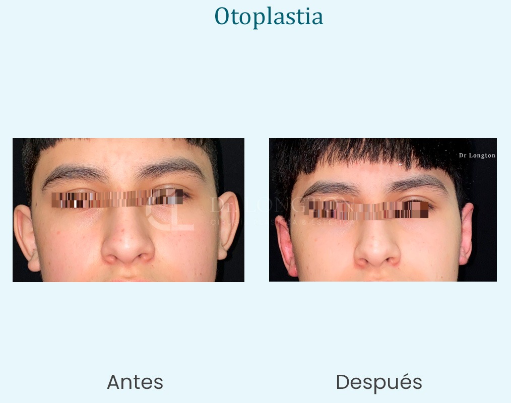 otoplastia caso antes y después