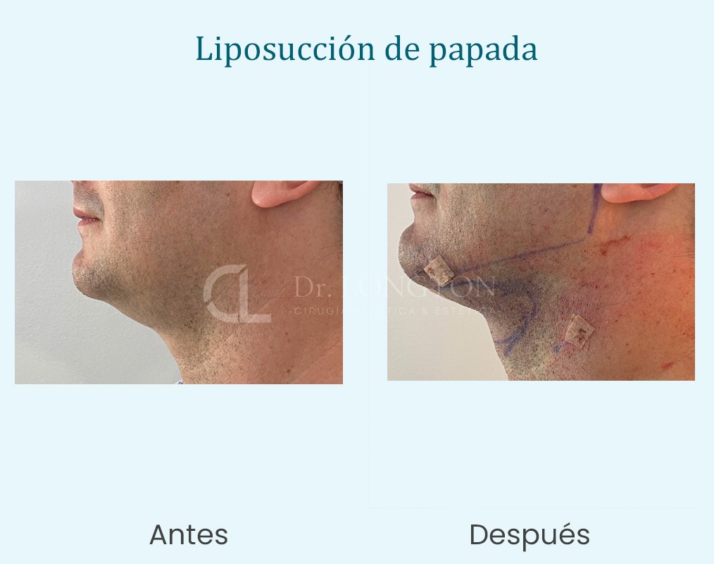 liposucción papada caso