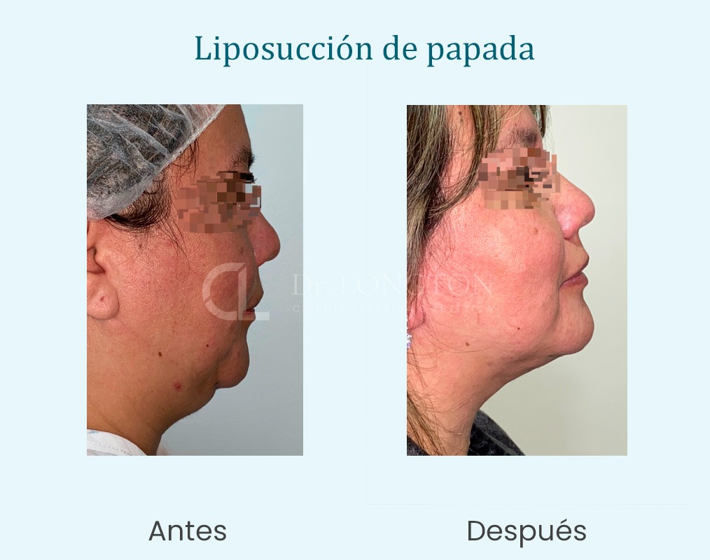 liposucción papada antes y después