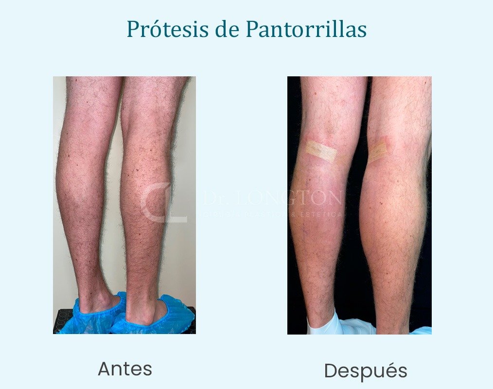 protesis pantorrilla antes y después