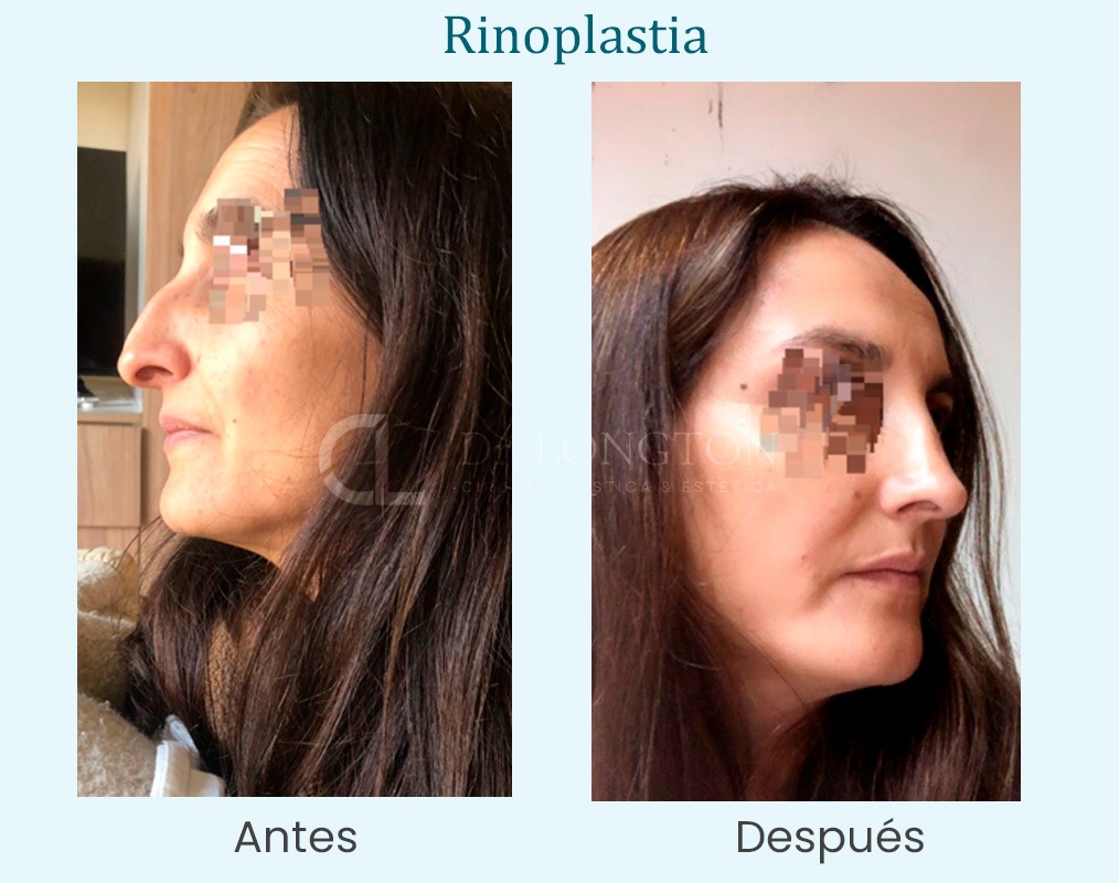 antes y después rinoplastia caso de exito