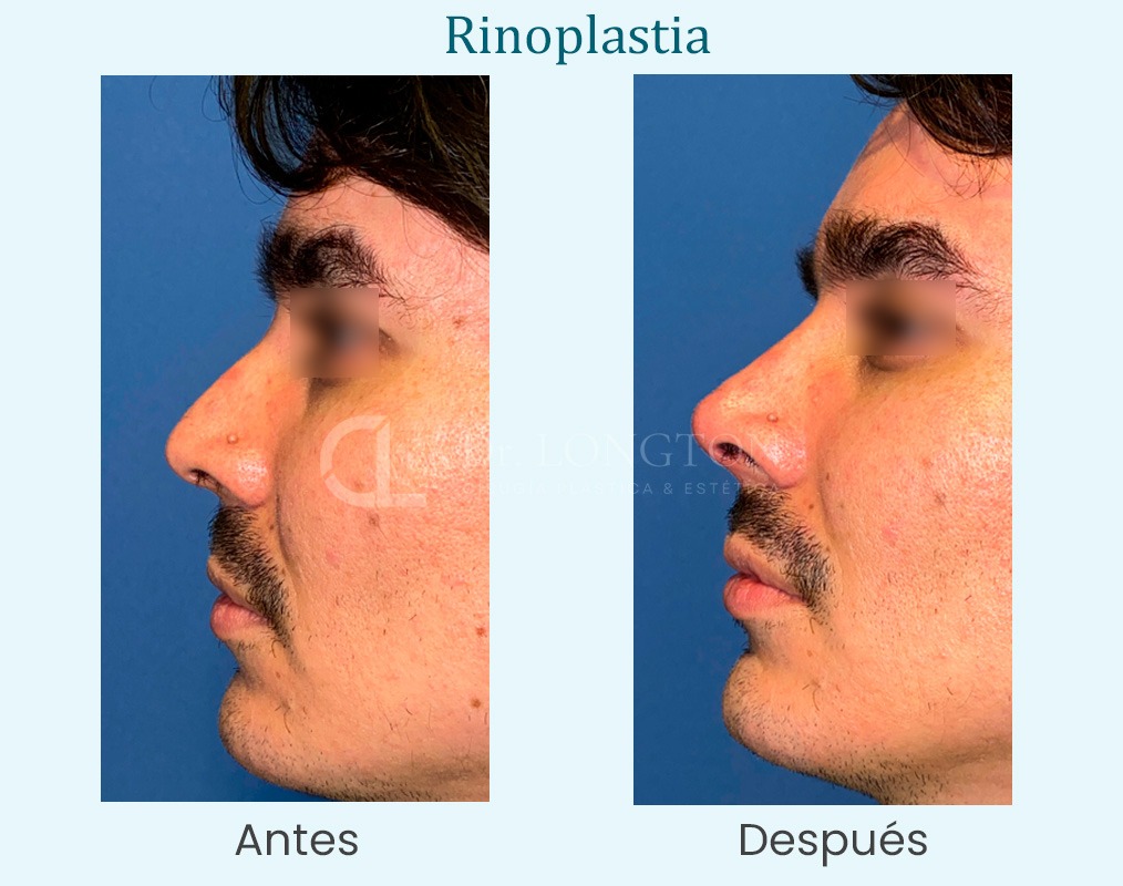 antes y después rinoplastia hombre