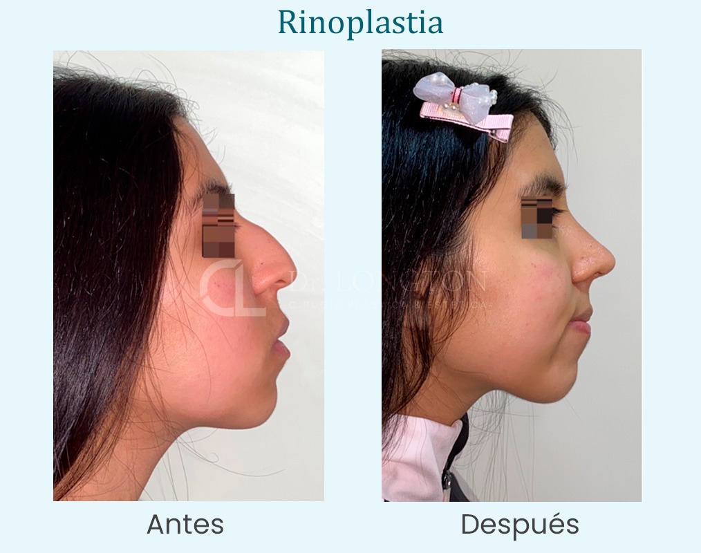 rinoplasti antes y después caso