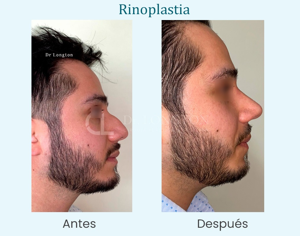 antes y después rinoplastia