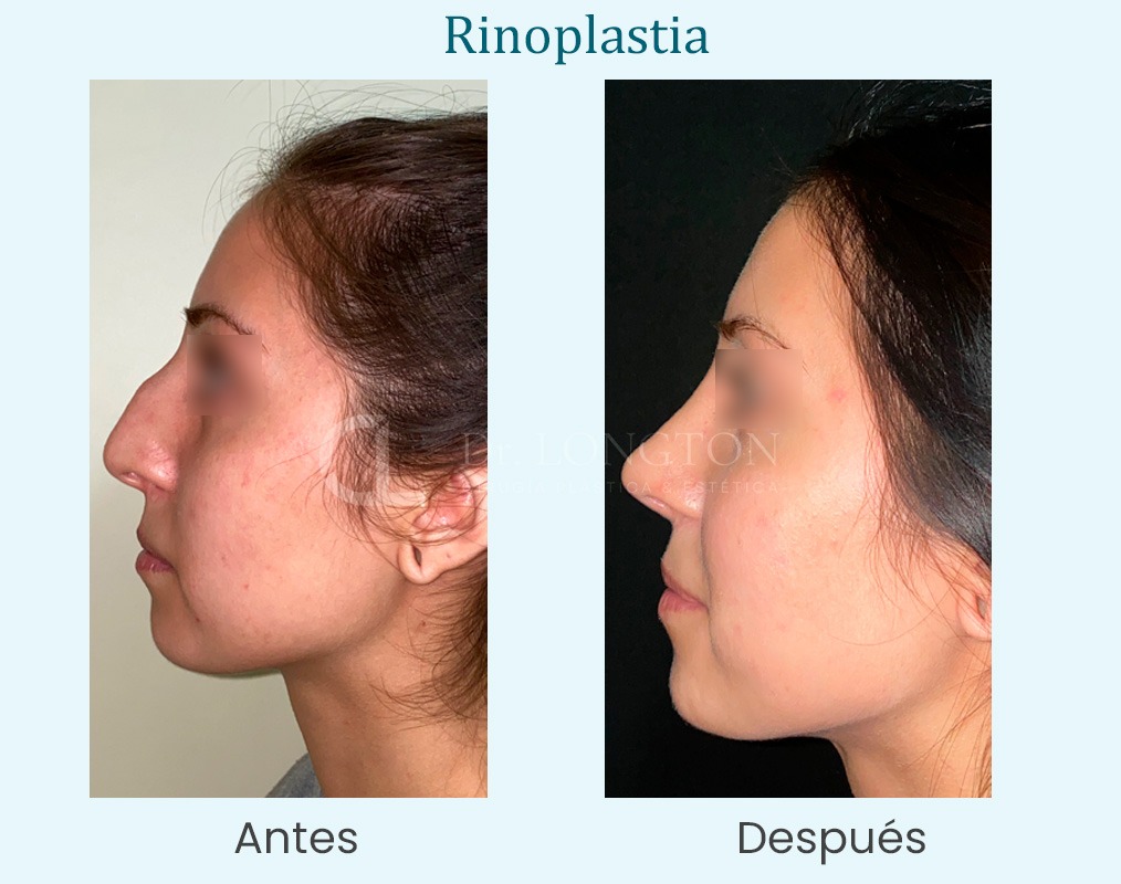 rinoplastia antes y después