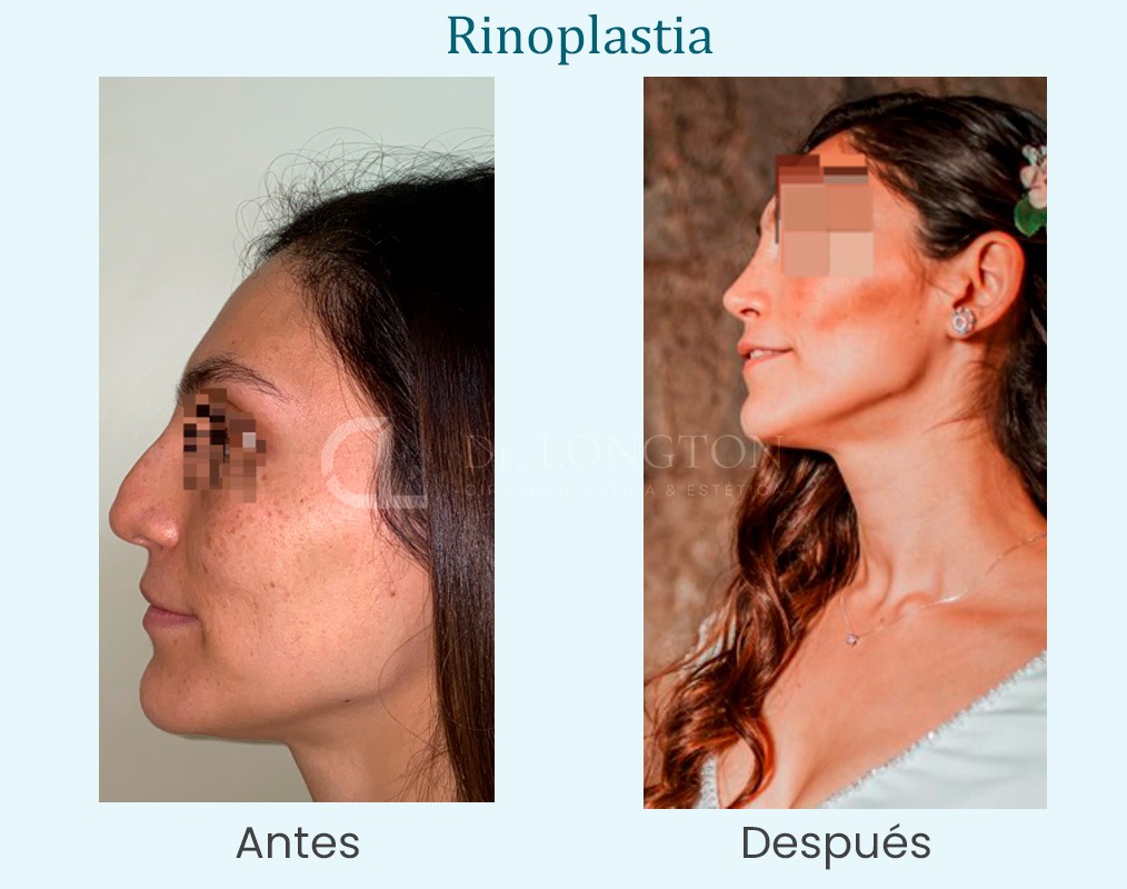 rinoplastia antes y después