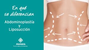 abdominoplastia y liposuccion diferencias