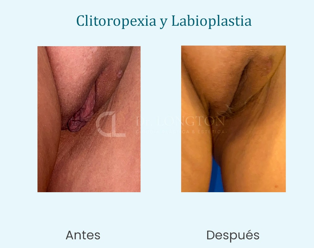 clitoropexia y labioplastia antets y después