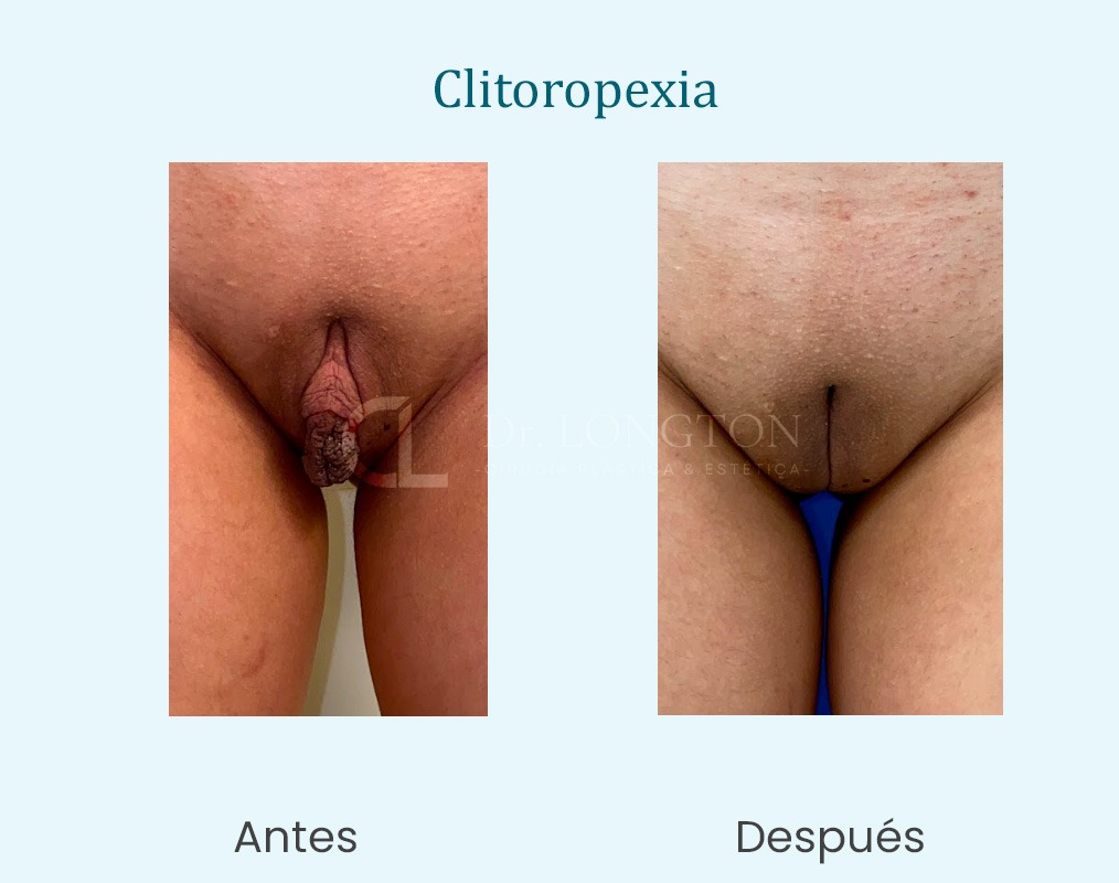 clitoropexia antes y después