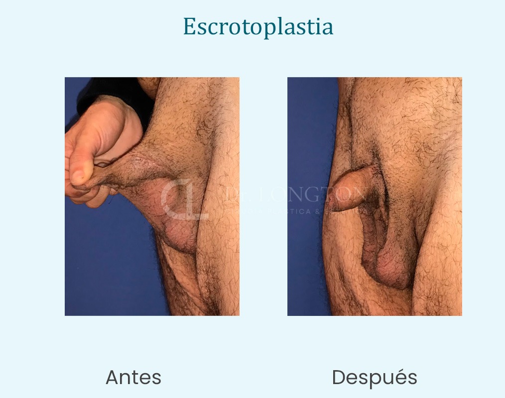 escritoplastia cirugía