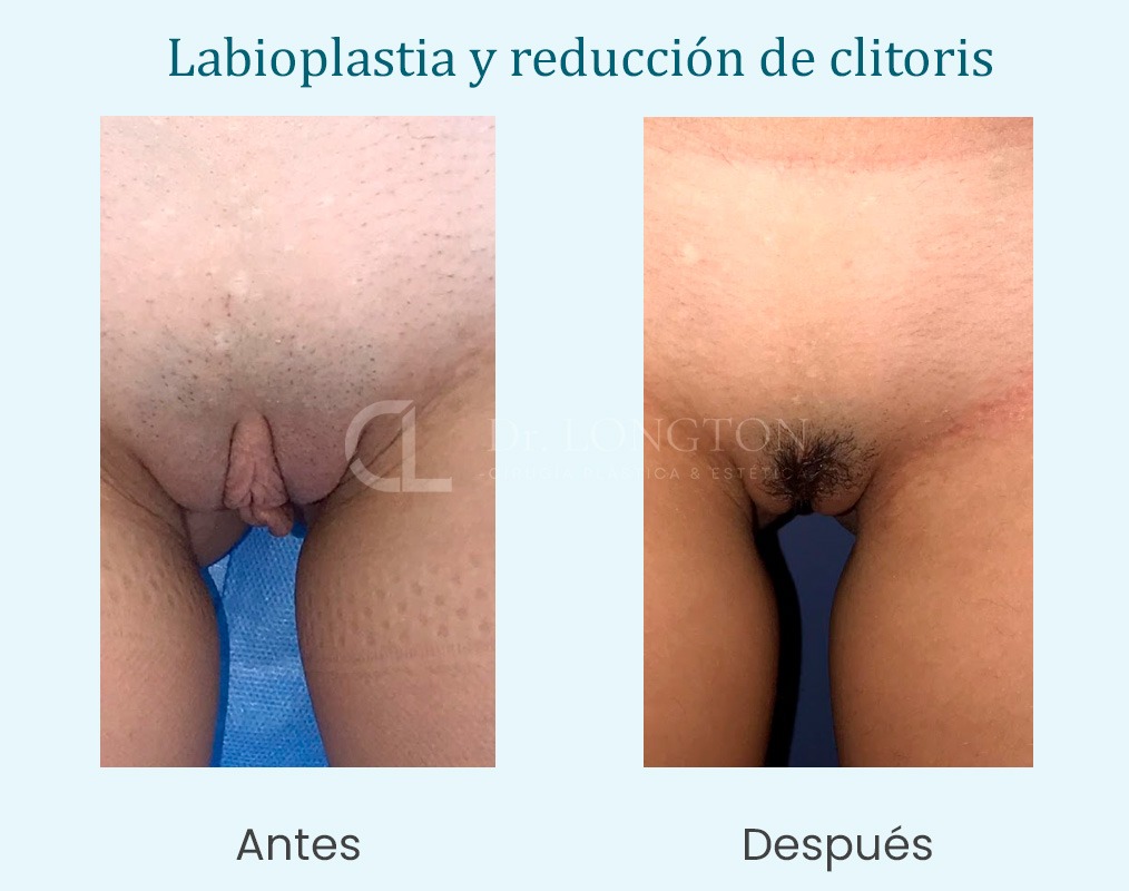 caso labioplastia y reduccion de clitoris