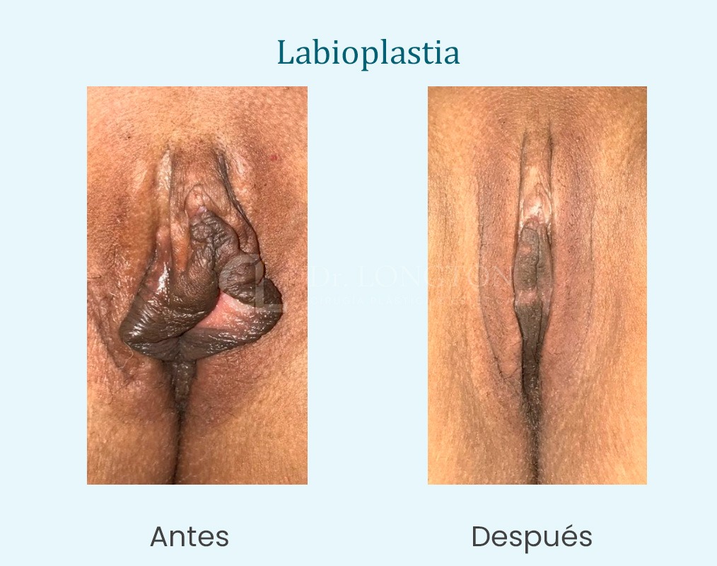 caso labioplastia